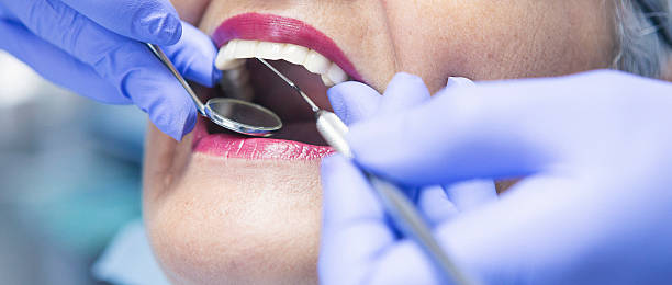 Best Emergency Dentist for Lost Fillings or Crowns in Northampton, PA